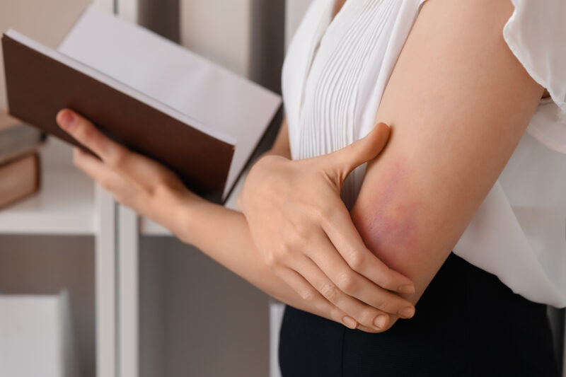 An employee holding a notebook in one hand and covering her bruised arm with the other hand, symbolising the hidden impact of domestic abuse on workplace wellbeing and performance